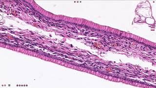 Ovary Mucinous cystadenocarcinoma [upl. by Forcier798]