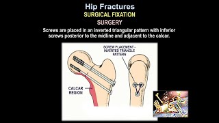 Hip Fractures Surgical Fixation  Everything You Need To Know  Dr Nabil Ebraheim [upl. by Yrnehnhoj274]