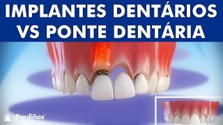 Implantes Dentários VS Ponte Dentária  Comparação © [upl. by Etnoled]