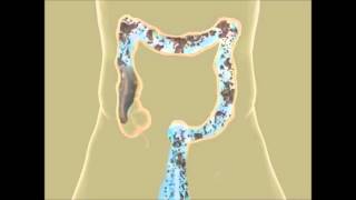 Colon Hydrotherapy in Pune  Constipation Treatment  Piles Treatment  Detox  Colon Cleansing IBS [upl. by Oilut]