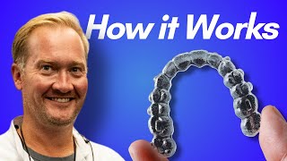 How Invisalign Works in 2024 [upl. by Assennav]