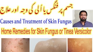 Fungal Skin Infection  Fungal Infection  Tinea Versicolor Treatment  Skin Fungus Yeast Infection [upl. by Rip192]