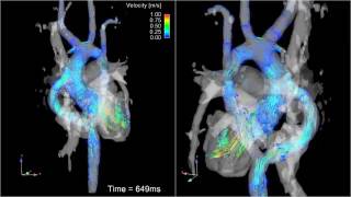 Blood Moving Through the Heart  4D Flow [upl. by Anialad897]