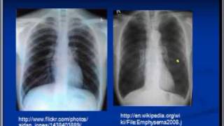 Chest xray interpretation COPD and Emphysema [upl. by Dodwell759]