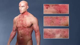 Atopic Dermatitis eczema From the Inside Out [upl. by Ruperta538]