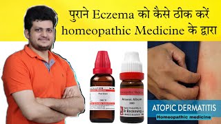 How to Cure Atopic Dermatitis  Homeopathic Medicine  full Treatment amp Precautions [upl. by Slinkman722]