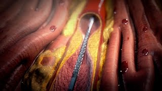 Stent Procedure [upl. by Aitropal54]