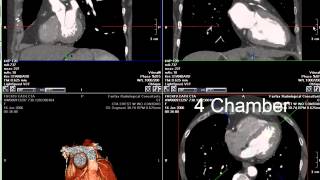 Coronary CT Angiography RCA Stenosis [upl. by Trudy]