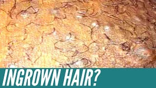 How to get rid of INGROWN HAIRS Expert tips that will get rid of them for good [upl. by Chesna449]