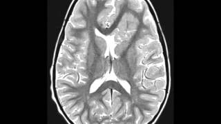 Cortical Dysplasia [upl. by Wildermuth]