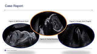 Cementoosseous Dysplasia in Collaboration w Western University [upl. by Kilmarx]