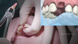 LIVE SURGERY DENTAL EXTRACTION AND BONE GRAFT [upl. by Nosmas818]