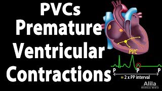 Premature Ventricular Contractions PVCs Animation [upl. by Pejsach120]