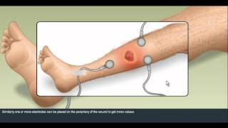 Short Transcutaneous Oxygen Measurement demo [upl. by Priscilla]