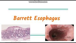 Barrett Esophagus [upl. by Averell457]