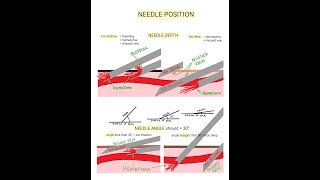 Venipuncture  How to Position a Needle [upl. by Aicirtal665]