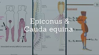 Cauda Equina amp Epiconus amp Conus Medullaris Lesions [upl. by Lodie19]