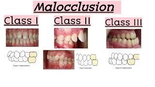 malocclusionsClass IClass IIClass IIIClinical featuresQuick Revision [upl. by Waldos214]