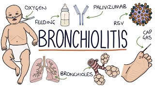 Bronchitis  Acute Bronchitis [upl. by Israeli]