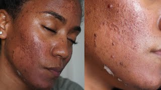 GREEN PEEL Full Process  Procedure Peeling Before amp After NO CHEMICAL PEEL [upl. by Mchugh920]