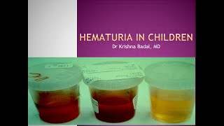 Hematuria in children [upl. by Michiko]