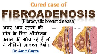 Fibroadenosis cured case [upl. by Odericus359]