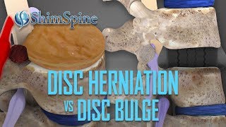 Disc Herniation vs Disc Bulge [upl. by Nalyac89]