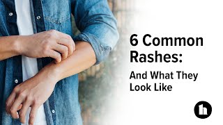 6 Common Rashes And What They Look Like  Healthline [upl. by Guillaume]