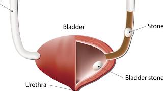 Urology Bladder stones [upl. by Sluiter]