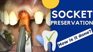 Tooth extraction and SOCKET PRESERVATION  How is it done [upl. by Ebanreb271]