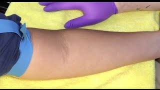 Tips For Locating Difficult Veins [upl. by Araed]