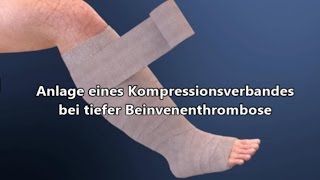 Kompressionsverband bei Thrombose [upl. by Larena539]