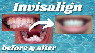 My Incredible Invisalign Transformation [upl. by Gilly630]