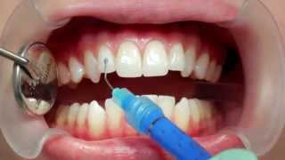 Placing Invisalign on your teeth [upl. by Rubliw]