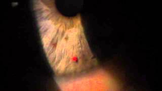 Laser Iridotomy and Narrow Angle  Michael J Pro MD [upl. by Atekihs]