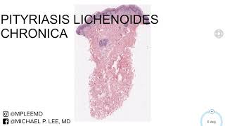 Pityriasis Lichenoides Chronica Dermpath Made Easy [upl. by Geirk]