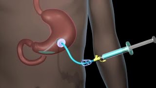 Technique for Chest Tube Insertion [upl. by Hanimay]